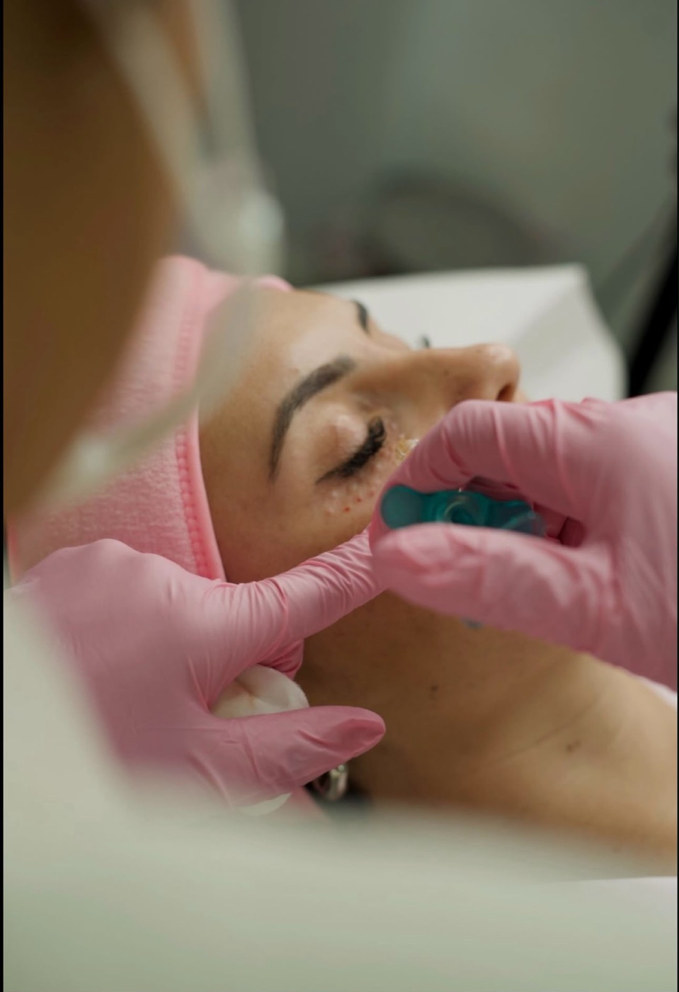 Aplicación de nanoterapia facial en la zona de las ojeras